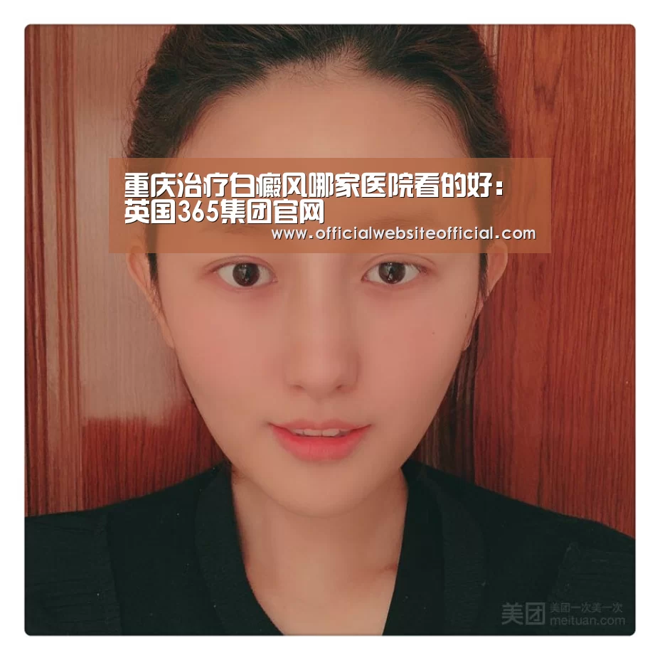 重庆治疗白癜风哪家医院看的好:英国365集团官网(图2) 英国365集团官网
